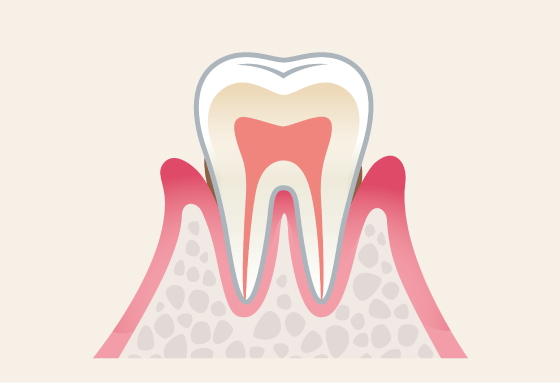 軽度歯周炎